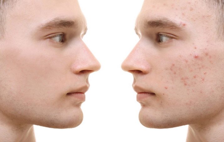 Косметика «Пропелер»: огляд уходових косметичних засобів проти прищів, відгуки косметологів