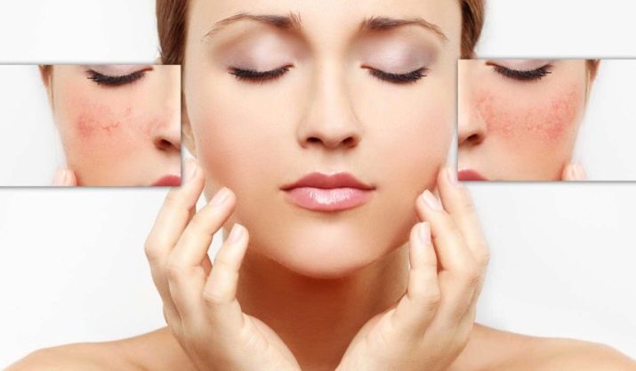 Міцелярна вода Uriage: для чутливої, жирної та іншої шкіри, особливості очисній мицеллярной води, правила застосування