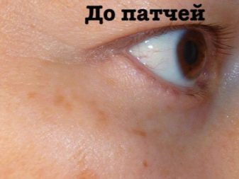 Патчі Blom: патчі для очей з микроиглами. Як вибрати і як правильно користуватися? Відгуки