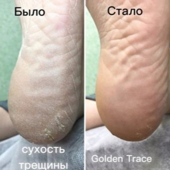 Педикюр Golden Trace: що це за косметика? Особливості препаратного ферментативного кошти, відгуки